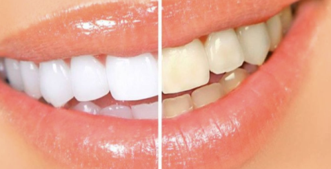Cara Memutihkan Gigi Kuning Secara Alami